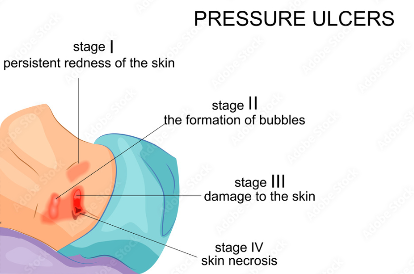 Pressure Ulcers